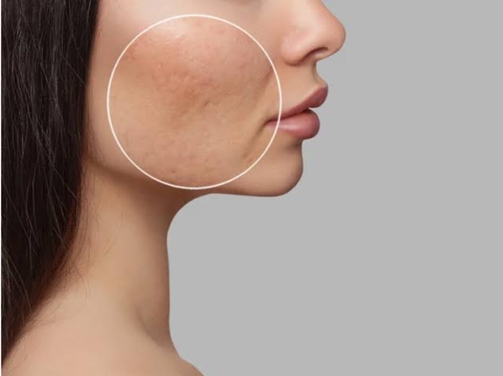 Micro-botox con microdosis para mejorar luminosidad y cerrar poros dentro de un protocolo — micro-botox y skin quality