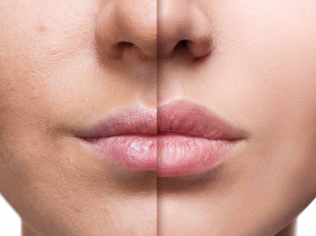 De qué depende la duración del ácido hialurónico en los labios y cómo se pierde el efecto — cuánto dura