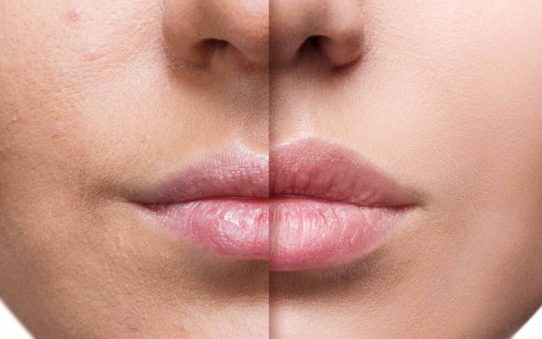 Cuánto dura el ácido hialurónico en los labios y de qué depende 